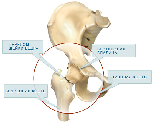 Перелом шейки бедра