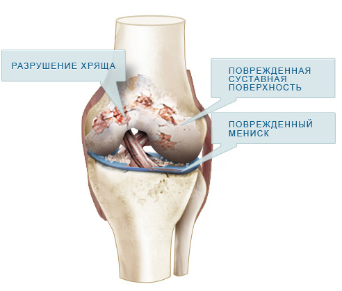 Остеоартроз коленного сустава (гонартроз)