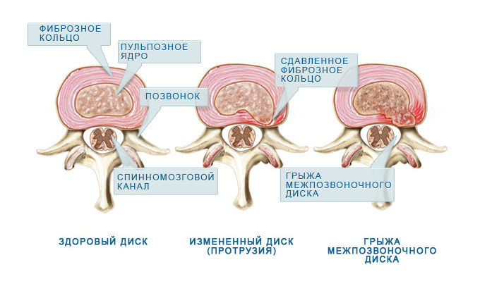 Этапы формирования грыжи межпозвоночного диска