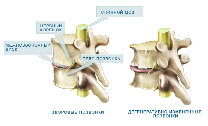 Стадии развития остеоартроза