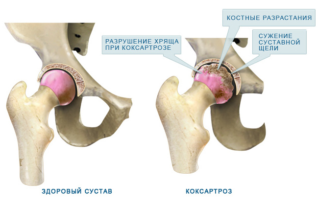 . Поражение тазобедренного сустава при остеоартрозе (коксартроз)