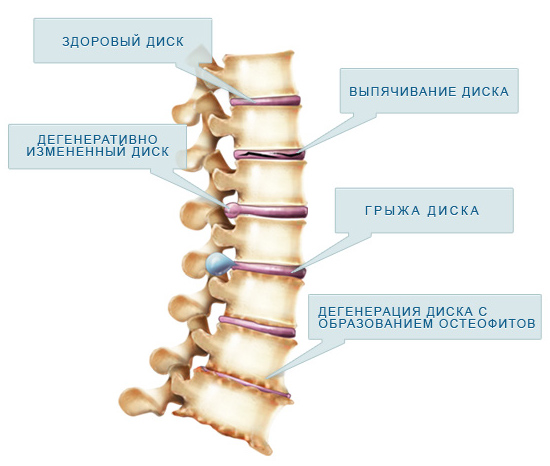 Дегенеративные изменения позвоночника