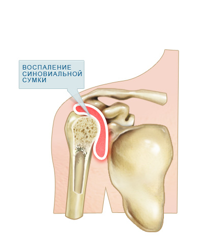 Бурсит плечевого сустава
