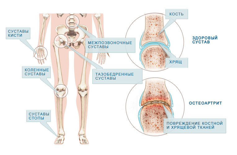Поражение суставов при ревматоидном артрите